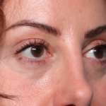 Blepharoplasty and Brow Lift Before & After Patient #34363